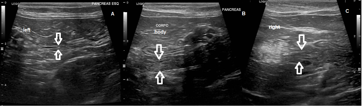 Figure 2: Ultrasound of the pancreas. A. Pancreas with normal dimensions in the left lobe measuring 0,45 cm (arrows). B. Increased dimensions in pancreatic body region measuring 0,77 cm (arrows). C. Dimensions on the right lobe measuring up to 0.94 cm (arrows), diffusely coarse echotexture, presence of oval, hypoechogenic, homogeneous images with slightly reduced echogenicity (pancreatopathy/fatty infiltrate with areas of nodular hyperplasia).