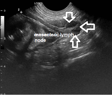 Figure 6: Ultrasound of the mesenteric lymph node. Lymph node with enlarged dimensions, measuring 4.5cm x 1.1cm (arrows), with a hypoechogenic and coarse appearance.