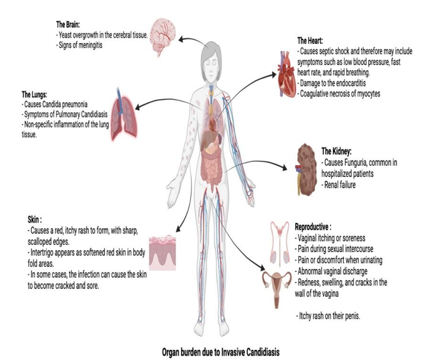Figure 1: An infected kidney can cause severe damage due to heavy necrotized areas with focal distribution of tubuli and multi-focal infiltration with yeast cells within the parenchyma tissue.