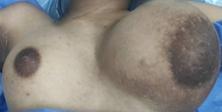Figure 1: Described lesion of the left mamma.