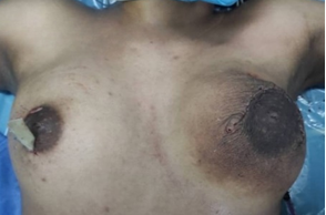 Figure 2: Surgical approach to both breasts and appearance in the immediate postoperative period.