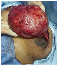 Figure 3: Intraoperative findings of the lesion.