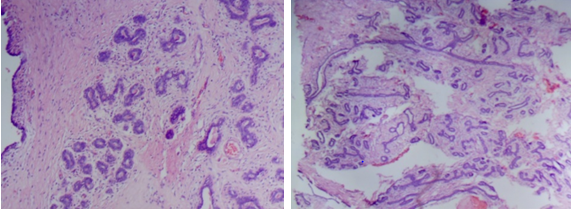 Figure 4: Histological section micrograph stained with hematoxylin and eosin, showing the aforementioned fibroepithelial neoplasm, being a proliferation of lactophoric ducts, some narrow and others branched, covered by a regular bistratified epithelium without atypia, under a loose fibroconnective stroma, without evidence of mitosis or necrosis.