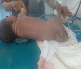 Figure 1: Neonate with sacrococcygeal mass.