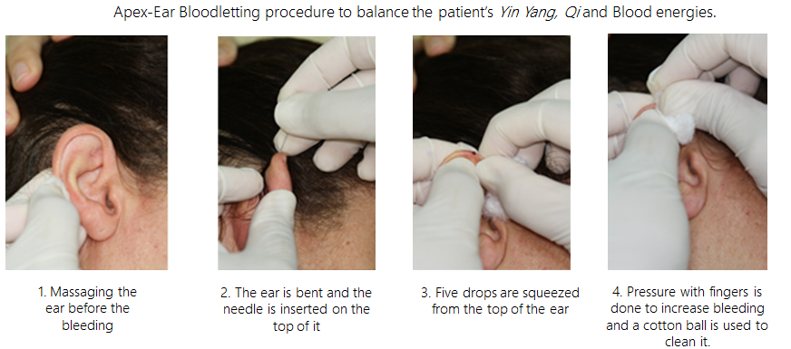Figure 9: Apex ear bloodletting takes out the internal Fire, responsible for the formation of cancer, in the energy point of view.
