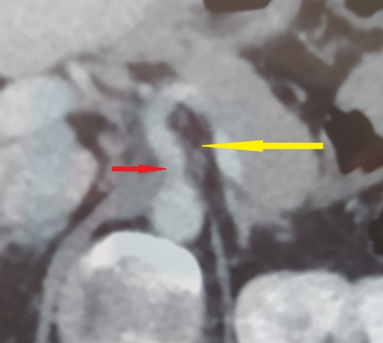 Figure 2: A false channel of the celiac trunk (red arrow) with an infiltration of the peri-vascular fatty tissue (yellow arrow).