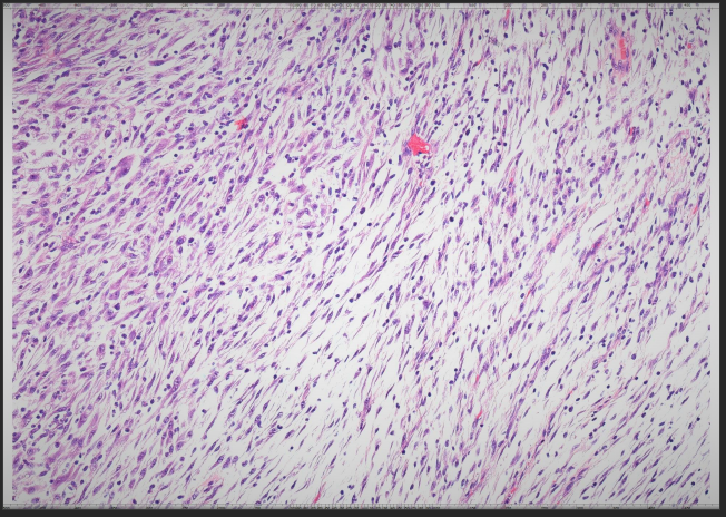 Figure 1: Microscopic image showing decidual tumor cells with abundant plump eosinophilic cytoplasm and focal myxoid changes. HE 20x.