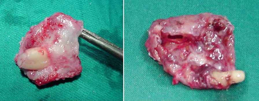 Figure 11: A photograph showing 2 freshly removed dentigerous cysts from 2 different patients with the offending missed tooth embedded in the cyst walls.