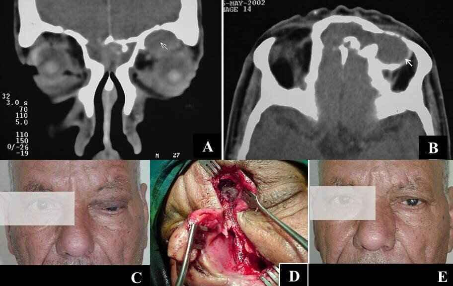 Figure 3: CT scan with coronal (A) and axial (B) soft tissue cuts showing a soft tissue shadow involving both frontoethmoid complexes with an absent inter-frontal septum and eroded posterior wall of right frontal sinus due to inverted papilloma, and a well-defined localized swelling in the medial orbital roof (white arrow) that is in continuity with the soft tissue shadow in the frontal complex (B) that proved to be pyocoele; (C) A preoperative photo showing a left-sided upper lid dusky swelling with a down displacement of the globe and orbital cellulitis; (D) Extended Moure’s lateral rhinotomy with localized frontal osteotomy to facilitate removal of the inverted papilloma that could be seen through the osteotomy; (E) Postoperative photo of the patient two weeks after surgery.