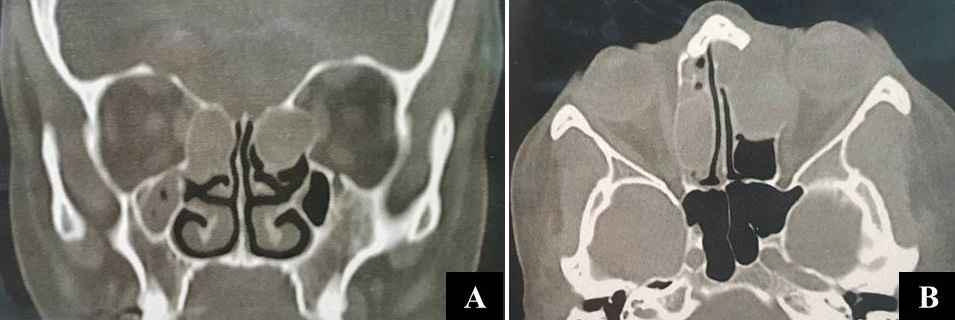 Figure 6: CT scan with coronal (A) and axial (B) bone window cuts showing soft tissue shadows involving anterior ethmoid air cells on both sides, proved to be pyoceles, with an erosion of the left lamina papyracea, orbital extension, and displacement of the left globe.