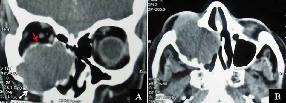 Figure 9: CT scan with coronal (A) and axial (B) soft tissue cuts showing a right-sided maxillary sinus mucocele distending the sinus with a displaced and partially eroded roof (red arrow), anterolateral wall (white arrow), and markedly displaced and eroded medial maxillary wall, hugging the nasal septum.