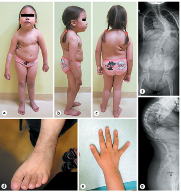 Figure 2: Another view of the types of disorders related to trisomy mosaic syndrome of chromosome 14 with spinal disorder in the form of spinal curvature and brown skin spots on the legs of a child with this syndrome [1].