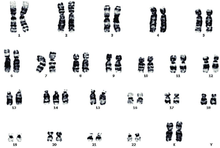 Figure 3: Schematic of the chromosomal karyotype of a human with mosaic trisomy of chromosome 14 [1].
