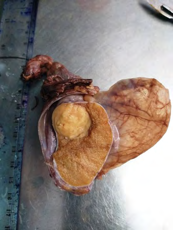 Figure 1: Cut section of testis shows well circumscribed gray, white solid mass with whirling pattern.