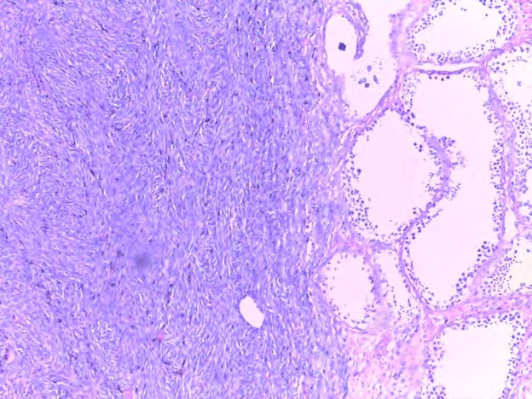Figure 3: Interlacing bundle of smooth muscle cell proliferation without atypia or mitosis.