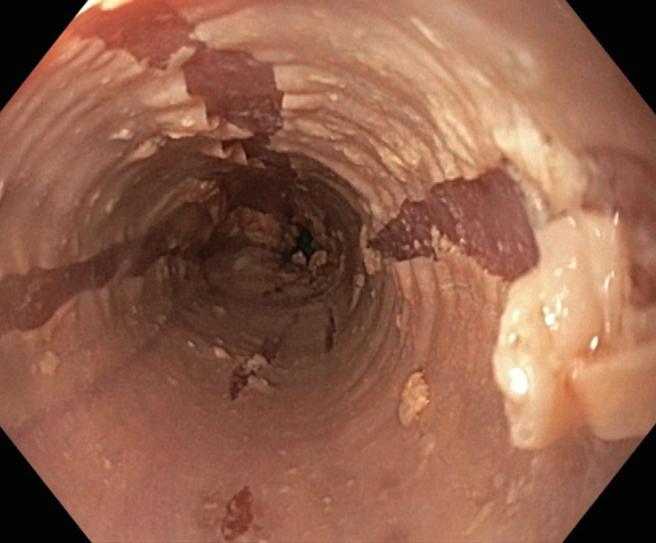 Figure 1: Upper endoscopy revealed the presence of streaks of peeled desquamated esophageal mucosa with circumferential cracks and long linear mucosa break.