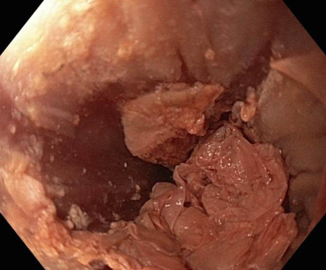 Figure 2: Endoscopic view of the lower third of the esophagus revealed clumps of exfoliated esophageal mucosa.
