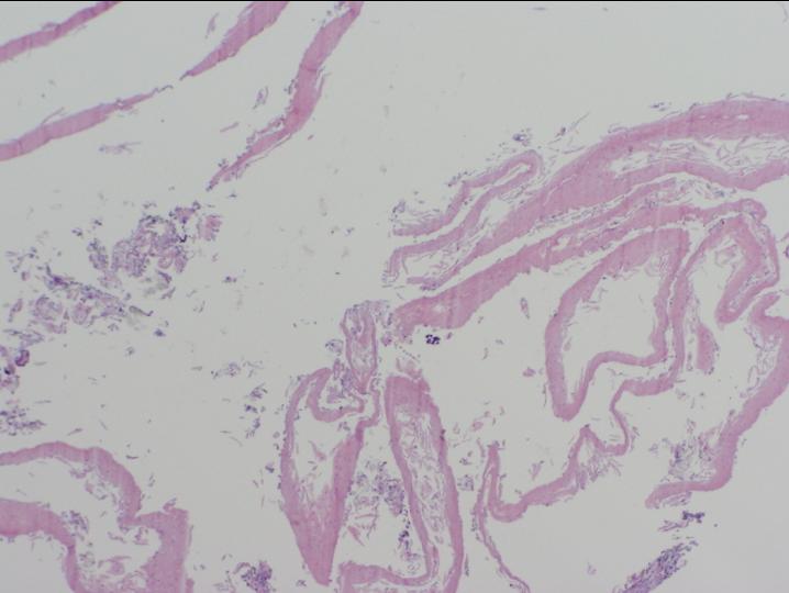 Figure 3: Histology: H & E stain demonstrated strips of superficial disaggregated epithelium of esophageal mucosa.