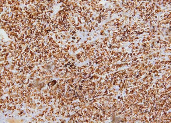 Figure 6: Bladder melanoma IHC, Tumor cells were positive for Hmb45.