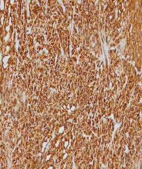 Figure 7: Tumor cells were positive for Melan A.