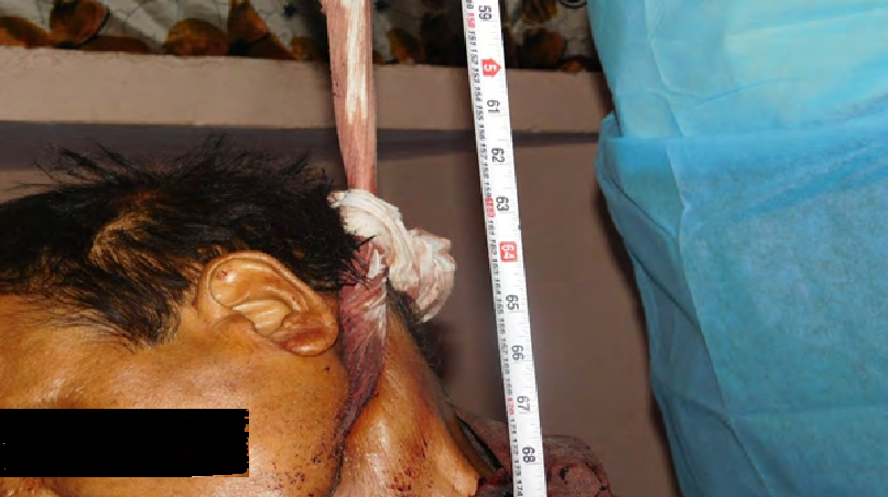 Figure 10: Ligature material smeared with blood.