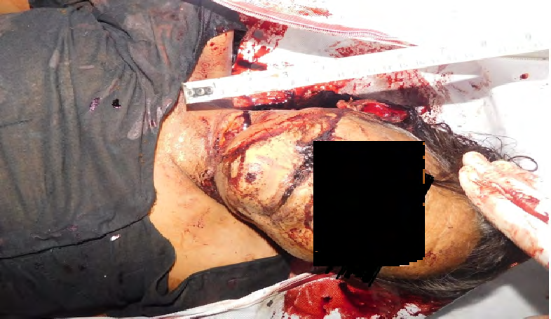 Figure 16: Visible slit injury on the neck near trachea.