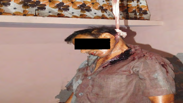 Figure 8: Male body hanging with ligature material, protruded tongue and cloth smeared with blood.