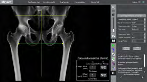 Figure 2: Preoperative planning for a 60-year-old patient with right coxarthrosis.