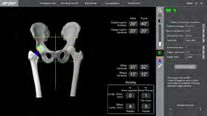 Figure 6: Final Results: Planned combined version of 32°, actual version of 33° including 13° femur starting from - 23°. Combined version in the safe range.