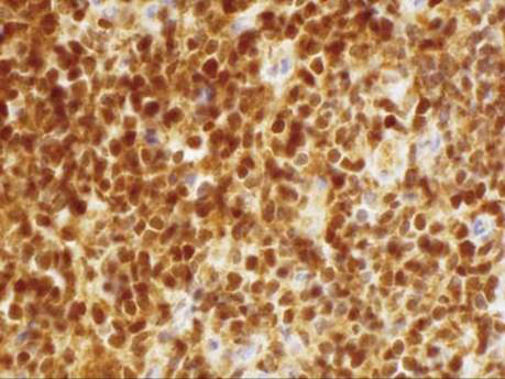Figure 2: T lymphoblastic lymphoma immune reactive to terminal deoxy-nucleotidyl transferase (TdT)(5).
