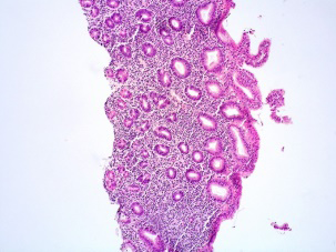 Figure 1: Indolent T lymphoproliferative disorder of gastrointestinal tract demonstrating a mucosal infiltrate of lymphoid cells incorporated with minimal cytoplasm, irregular nuclear contour, coarse nuclear chromatin and indiscernible nucleoli. Foci of mucosal ulceration, necrosis, angio-destruction or angio-centricity are absent.
