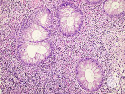 Figure 2: Indolent T lymphoproliferative disorder of gastrointestinal tract delineating mucosal infiltration of monoclonal lymphoid cells permeated with scanty cytoplasm, irregular nuclear outline, mature nuclear chromatin and inconspicuous nucleoli. Foci of mucosal ulceration or necrosis are absent.