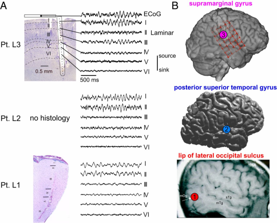 Figure 5: Figure illustrates Laminar recordings of cortical alpha. (A) Nissl stains of the explanted tissue surrounding the laminar probe in Pts. L1 and L3, in addition to representative laminar CSD traces from each layer in each subject. Note that despite being made in distinct cortical locations, alpha oscillations were always strongest in layer I/II. Furthermore, in L3, the trace of a simultaneously recorded overlying ECoG contact is near identical to the underlying laminar layer I. (B) Locations of each laminar probe in all patients [11].