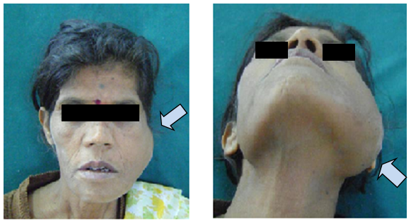 Figure 1: Extraoral swelling (blank arrows).