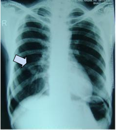 Figure 3: A computerized tomographic (CT) showing an osteolytic lesion involving condyle, coronoid, portion of ramus of mandible on left side with lamellar osteogenesis with sunburst configuration (red oval). A large soft tissue component measuring 5.5 x 5cm can be noted causing cortical thinning at posterolateral wall of maxillary antrum, medially involving the pterygoid muscle, extending upto the parapharyngeal space and laterally involving the masseter muscle and parotid gland, posteriorly extending upto the styloid process (blank arrows).