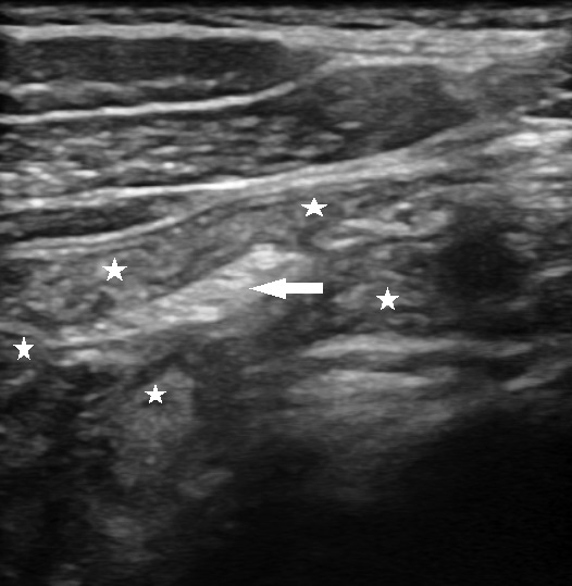 Figure 1: Small bowel loops (white arrows) surround mesentery (arrow) - normal ultrasound finding.