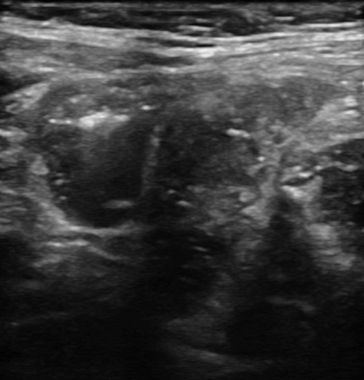 Figure 5: Ileal ultrasound: ileal loops filled with small amount of fluid without changes in mesentery.