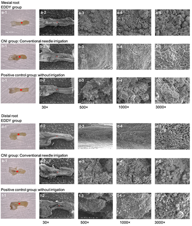 Figure 2: Morphology of the biofilm in the root canal and observation of dentinal wall after irrigation using scanning electron microscopy. Root canals in the positive control groups (c) and (f) were found to have layered biofilm formation on the walls. Those in the EDDY group (a) had a layer of biofilm (consisting mainly of cocci aggregates) on the walls that obliterated the opening of the dentinal tubules. After using EDDY (d), the biofilm was removed, and the patency of the dentinal tubules was re-established. As seen in (d-2), the curved morphology of the canals was maintained from the cervical to apical parts, and no perforations or fractures were observed. As seen in (d-5), the morphology of the dentinal tubule opening was maintained, and no evidence of unnecessary cutting in the form of waves was observed. In the CNI group (b), the biofilm, an aggregate of cocci and rods, persisted in layers on the root canal walls and obliterated the opening of the dentinal tubules. CNI, conventional needle irrigation High-magnification images showed that regardless of the enlarged canal size, the biofilm structure was layered, consisting mainly of spherical bacteria with some aggregating rod-shaped bacteria (c-3 to 5 and f-3 to 5). Although no biofilm-like deposits were visible in a mesial root canal of the EDDY group (a-1), thin biofilm structures covering the root canal were seen in SEM (a-2 to 5). On the other hand, distal roots showed the removal of biofilm structures throughout the root canal visually (d-1 to 4), no wave-like cutting marks were evident with opening of the dentinal tubules (d-5). The biofilm structure was also similar to the specimens in the positive control group, regardless of the size of root canal enlargement (b-1 to 5 and e-1 to 5).