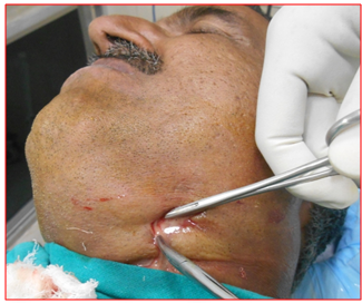 Figure 4: Drainage of Lt Submandibular space.