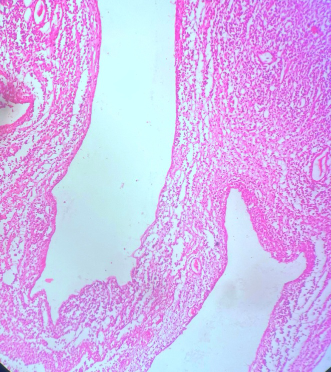 Figure 3: Photomicrograph showing mesenteric cyst lined by flattened epithelium (H&E stain,100x)