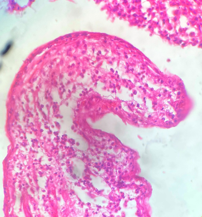 Figure 4: Photomicrograph showing mesenteric cyst lined by flattened epithelium, cyst wall with inflammation (H&E stain, 400x).
