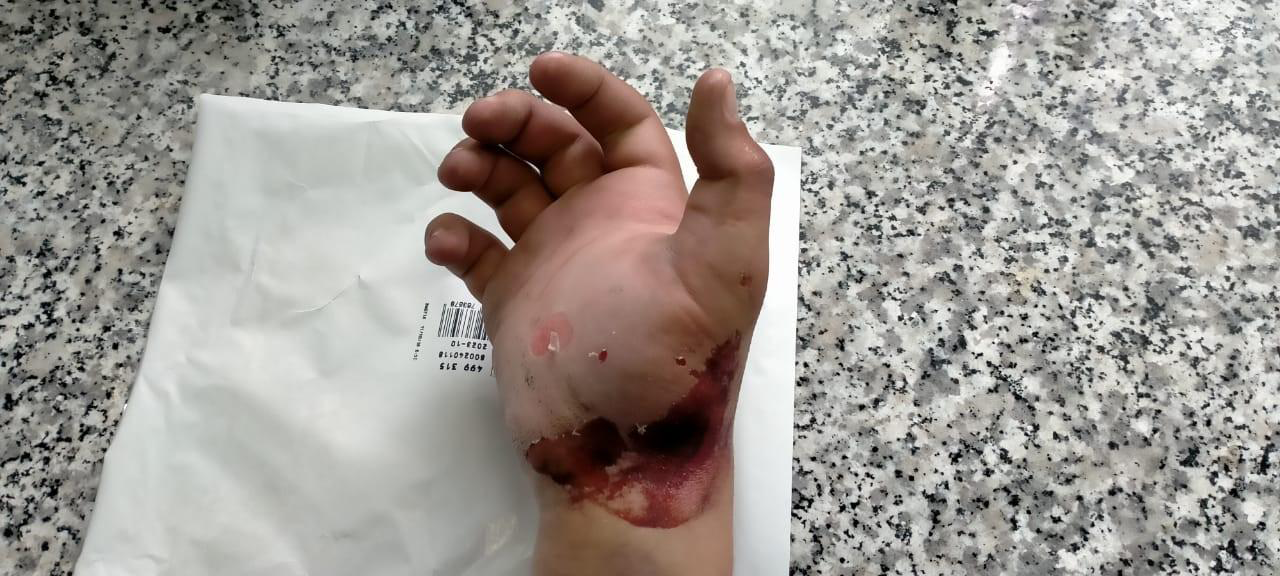Figure 1: Preoperative hand aspect showing the appearance of compartment syndrome in the hand.