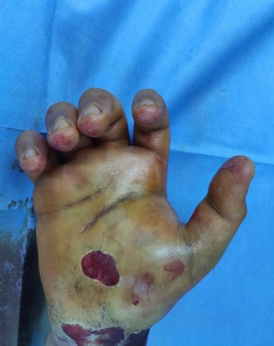 Figure 2: preoperative radiograph reveals several metacarpal fracture.