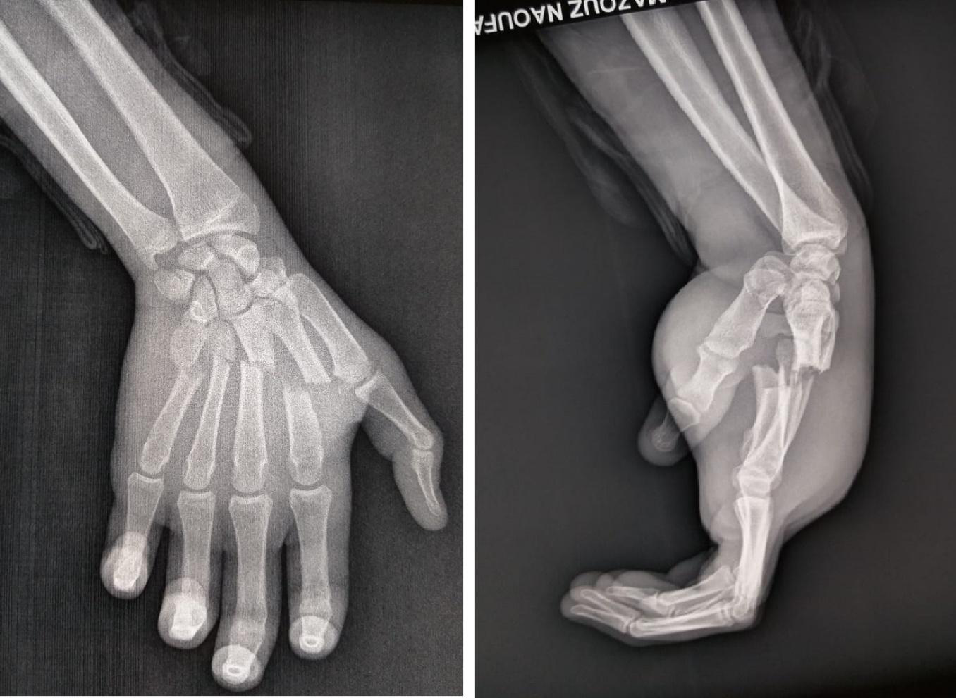 Figure 4: discharge incisions on the dorsal face and at the level of the carpal canal.
