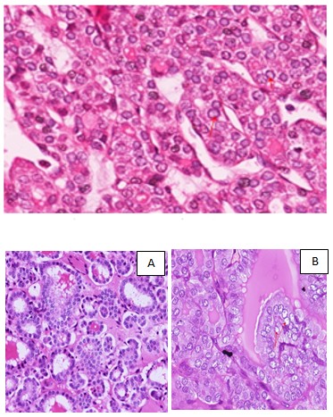 Figure 15: Follicles with nuclear features without psammoma or necrosis H&E X400.