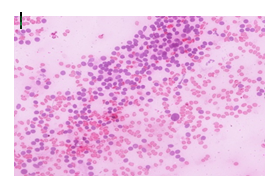 Figure 4: CIII FNAC case showing enlarged atypical cells H&E X200.