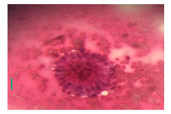 Figure 6: CV FNAC case showing microfollicle with cytologically enlarged cells H&E X400.