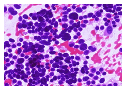 Figure 7: CV FNAC case showing cytologically atypical enlarged cells H&E X400.