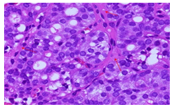 Figure 9: Cell block case showing microfollicles lined by crowded cells H&E X400.