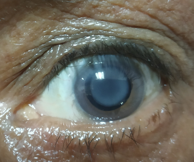 Figure 1: Moon in the eye.